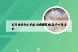 银屑病做别的手术 身患银屑病,做手术可以吗