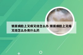 银屑病脸上又痒又烧怎么办 银屑病脸上又痒又烧怎么办用什么药