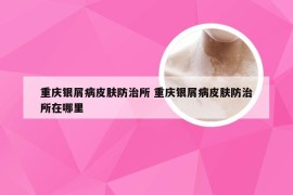 重庆银屑病皮肤防治所 重庆银屑病皮肤防治所在哪里