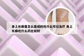 身上长癣是怎么造成的吃什么可以治疗 身上长癣吃什么药比较好