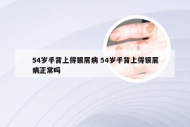 54岁手背上得银屑病 54岁手背上得银屑病正常吗