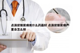 点滴状银屑病用什么药最好 点滴状银屑病严重会怎么样