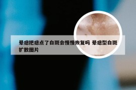 晕痣把痣点了白斑会慢慢恢复吗 晕痣型白斑扩散图片