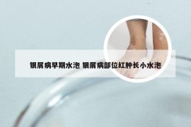 银屑病早期水泡 银屑病部位红肿长小水泡