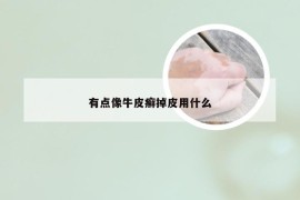 有点像牛皮癣掉皮用什么