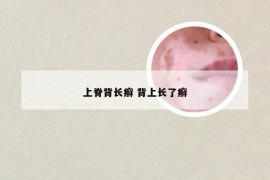 上脊背长癣 背上长了癣