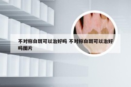 不对称白斑可以治好吗 不对称白斑可以治好吗图片