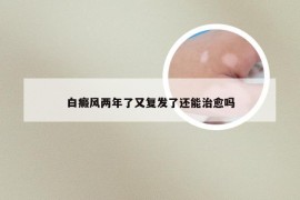 白癜风两年了又复发了还能治愈吗