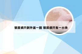 银屑病只剩外面一圈 银屑病只有一小块