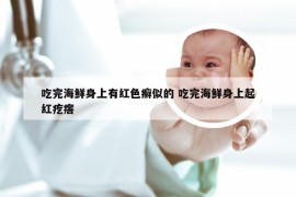 吃完海鲜身上有红色癣似的 吃完海鲜身上起红疙瘩