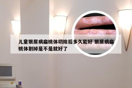 儿童银屑病扁桃体切除后多久能好 银屑病扁桃体割掉是不是就好了