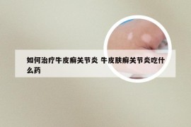 如何治疗牛皮癣关节炎 牛皮肤癣关节炎吃什么药