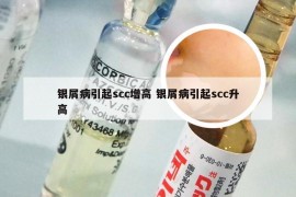 银屑病引起scc增高 银屑病引起scc升高