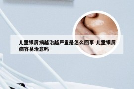 儿童银屑病越治越严重是怎么回事 儿童银屑病容易治愈吗