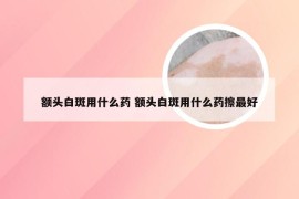 额头白斑用什么药 额头白斑用什么药擦最好