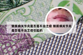 银屑病关节炎是否是不治之症 银屑病关节炎是否是不治之症引起的