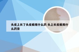 头皮上长了头皮癣用什么药 头上长皮癣用什么药膏