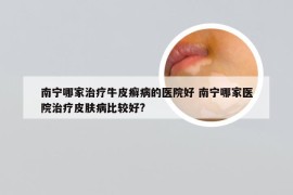 南宁哪家治疗牛皮癣病的医院好 南宁哪家医院治疗皮肤病比较好?