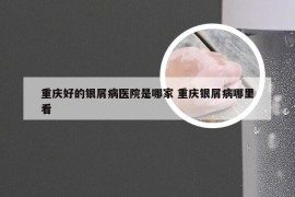 重庆好的银屑病医院是哪家 重庆银屑病哪里看