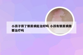 小孩子得了银屑病能治好吗 小孩有银屑病需要治疗吗