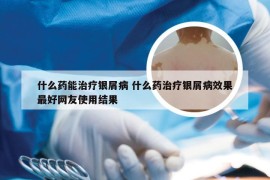 什么药能治疗银屑病 什么药治疗银屑病效果最好网友使用结果