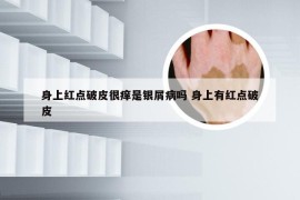 身上红点破皮很痒是银屑病吗 身上有红点破皮