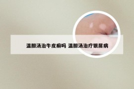 温胆汤治牛皮癣吗 温胆汤治疗银屑病