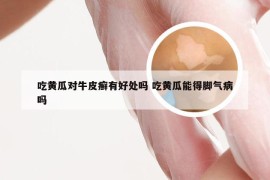 吃黄瓜对牛皮癣有好处吗 吃黄瓜能得脚气病吗