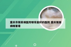 重庆市银屑病医院哪家最好的医院 重庆银屑病哪里看