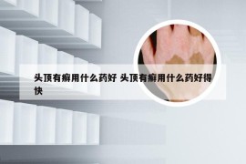 头顶有癣用什么药好 头顶有癣用什么药好得快