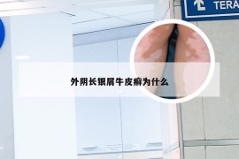 外阴长银屑牛皮癣为什么