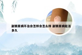 副银屑病不治会怎样会怎么样 副银屑病能活多久