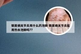 银屑病关节炎用什么药泡脚 银屑病关节炎能用热水泡脚吗??