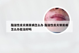 脂溢性皮炎银屑病怎么办 脂溢性皮炎银屑病怎么办能治好吗