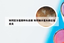 如何区分是那种头皮癣 如何确诊是头癣还是皮炎