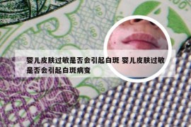 婴儿皮肤过敏是否会引起白斑 婴儿皮肤过敏是否会引起白斑病变