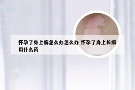 怀孕了身上癣怎么办怎么办 怀孕了身上长癣用什么药