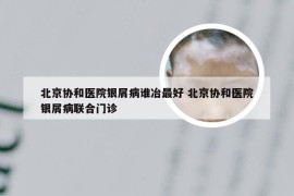 北京协和医院银屑病谁冶最好 北京协和医院银屑病联合门诊