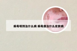 癣毒喷剂治什么病 癣毒康治什么皮肤病