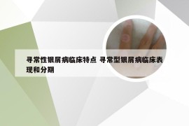 寻常性银屑病临床特点 寻常型银屑病临床表现和分期