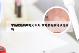 掌跖脓疱病烤电可以吗 掌跖脓疱病可以泡澡吗