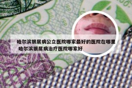 哈尔滨银屑病公立医院哪家最好的医院在哪里 哈尔滨银屑病治疗医院哪家好