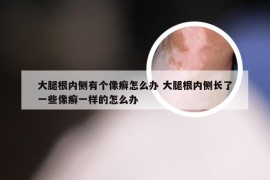 大腿根内侧有个像癣怎么办 大腿根内侧长了一些像癣一样的怎么办