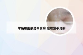 掌跖脓疱病是牛皮癣 糜烂型手足癣