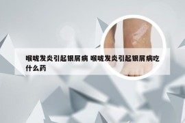 喉咙发炎引起银屑病 喉咙发炎引起银屑病吃什么药