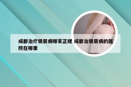 成都治疗银屑病哪家正规 成都治银屑病的医院在哪里