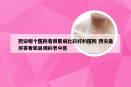 西安哪个医院看银屑病比较好的医院 西安最厉害看银屑病的老中医