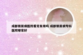 成都银屑病医院看完有用吗 成都银屑病专科医院哪家好