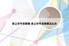 身上长牛皮肤癣 身上长牛皮肤癣怎么办