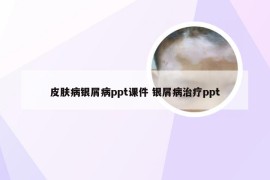 皮肤病银屑病ppt课件 银屑病治疗ppt